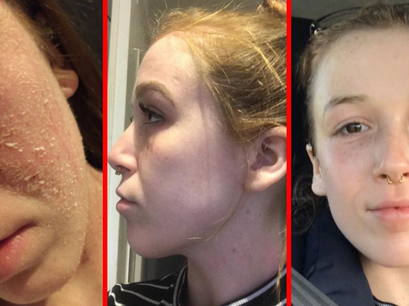 Erstaunliche Heilung der Haut durch natürliche Kosmetik – Bessere Haut in nur wenigen Tagen Erstaunliche Heilung der Haut durch natürliche Kosmetik – Bessere Haut in nur wenigen Tagen